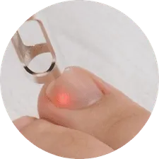 Remoción Láser para Hongos en Uñas Minerva Estetic