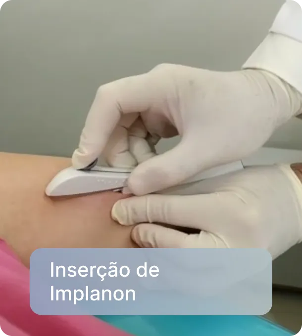 Inserção de Implanon