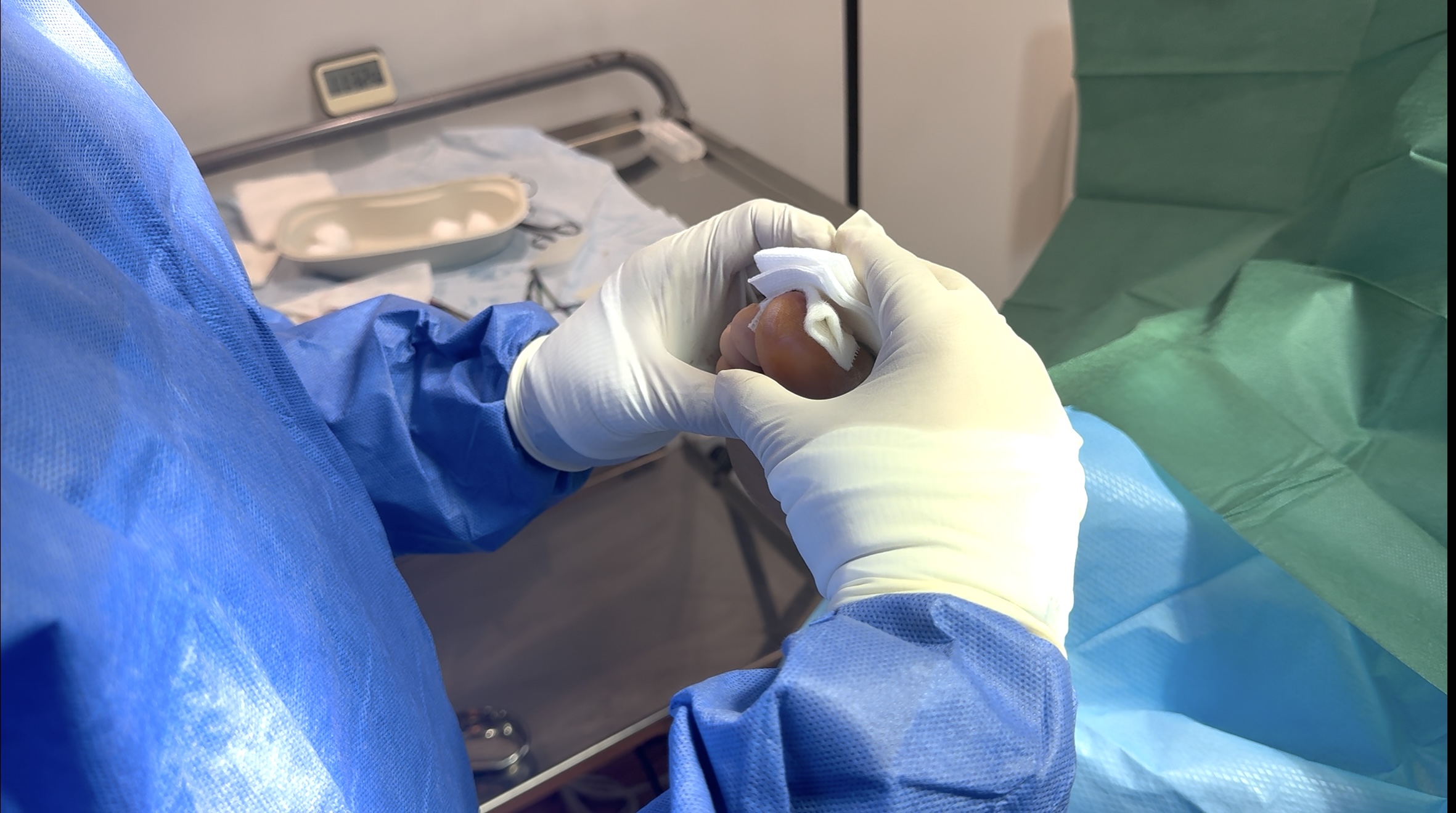 Professional nail surgery treatment for ingrown toenails in the UK