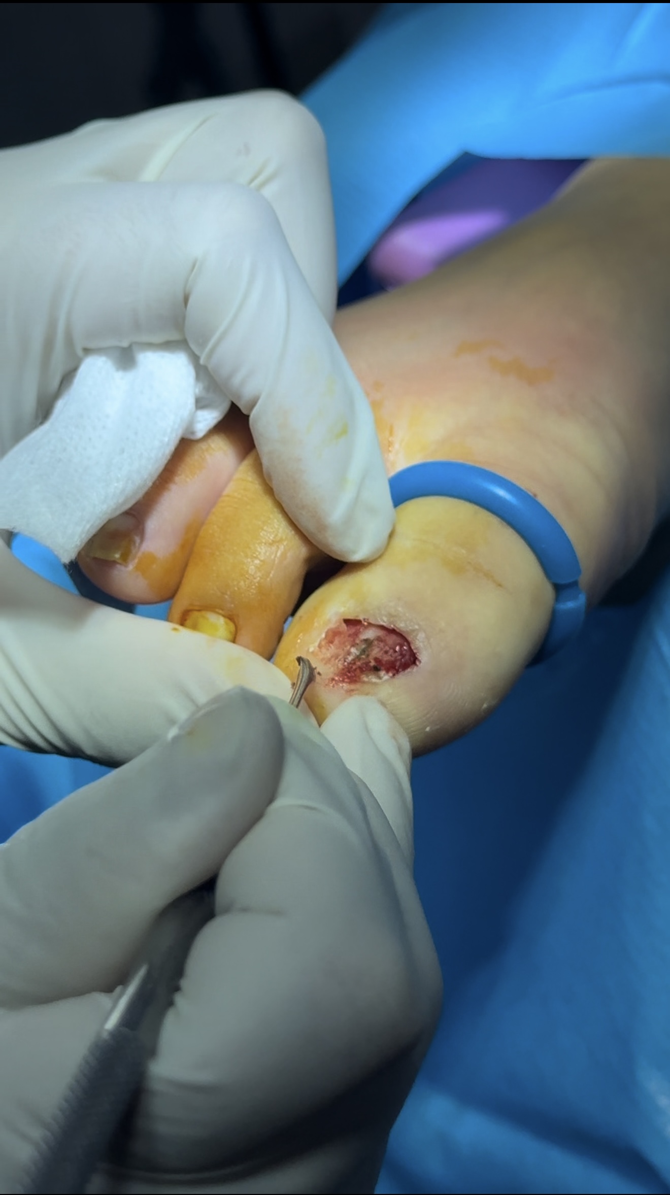 Fungal nail surgery procedure showing nail bed cleaning