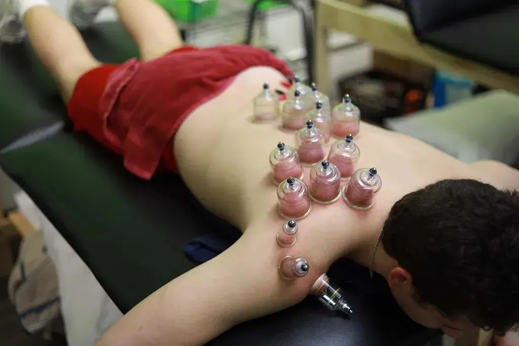 Cupping Therapy