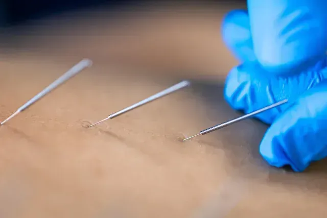acupuncture