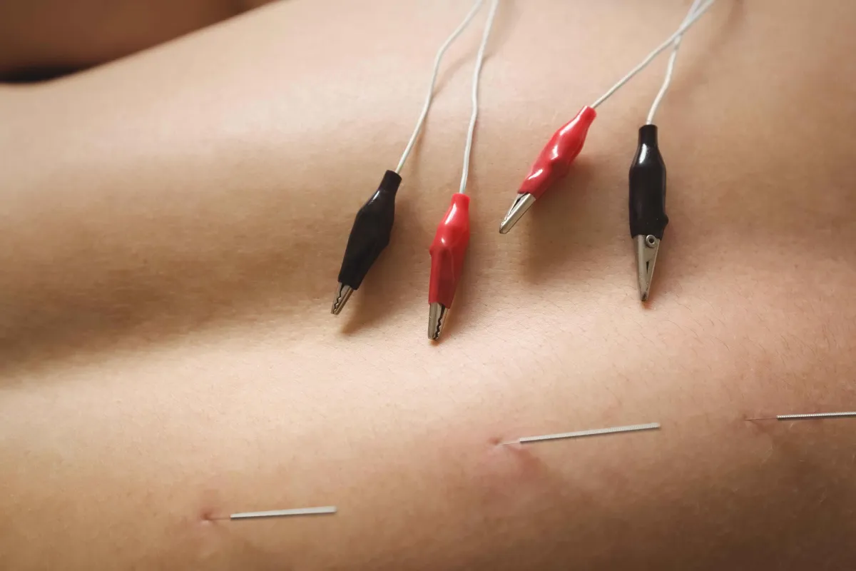 Acupuncture for Back Pain in Clifton, NJ
