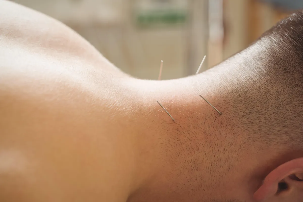 Acupuncture for Neck Pain in Clifton, NJ