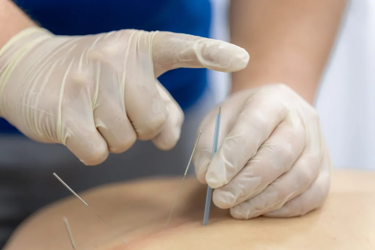 Dry Needling for Back Pain in NJ