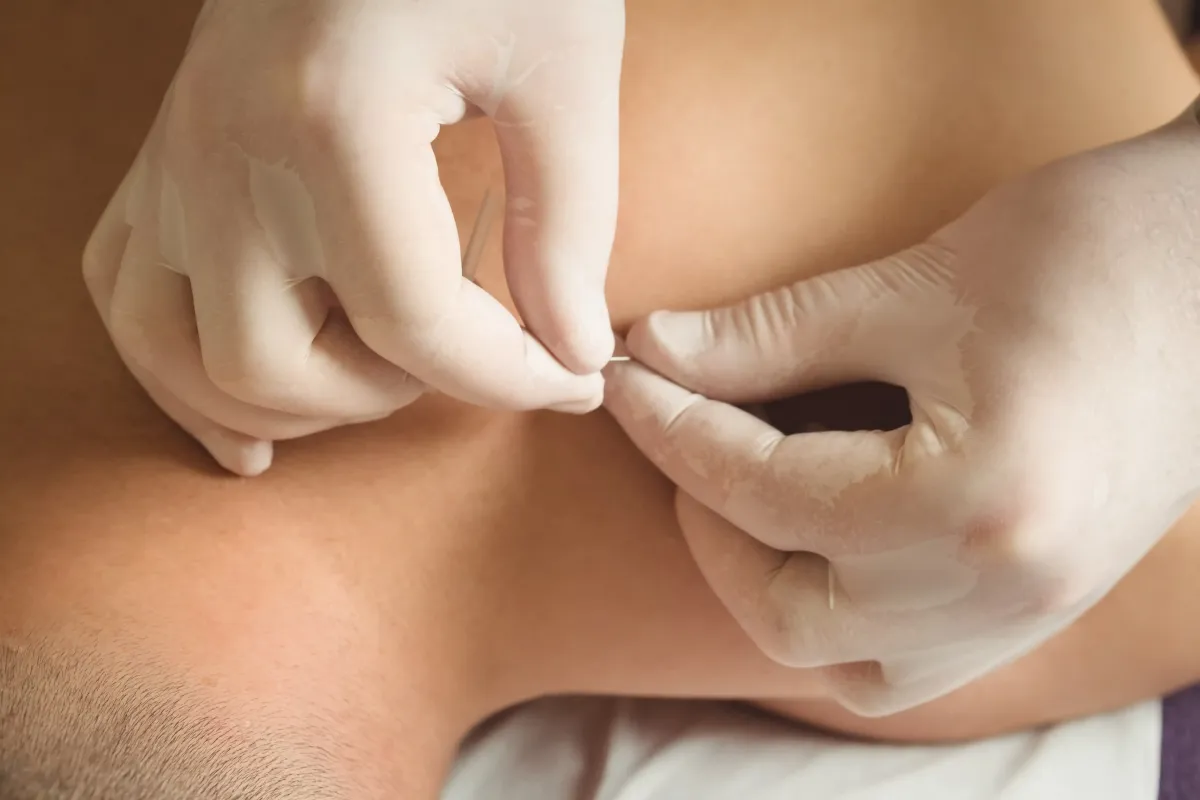 Dry Needling for Trapezius Pain in NJ