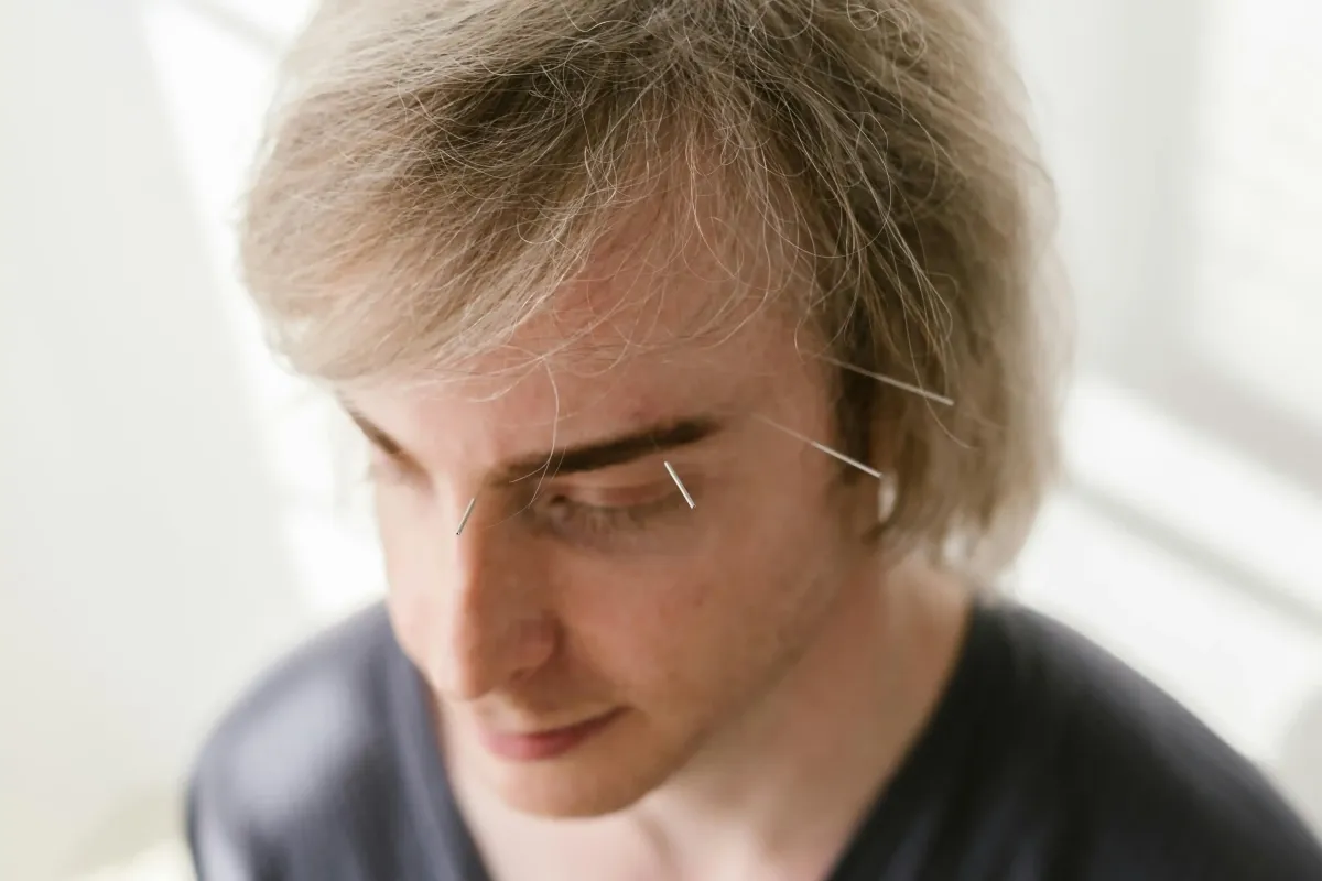 Dry Needling For Tension Headaches In NJ