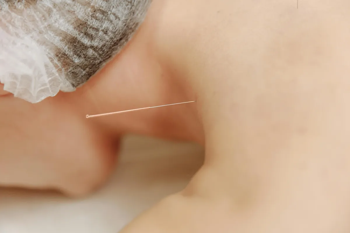 Dry Needling for Frozen Shoulder in NJ
