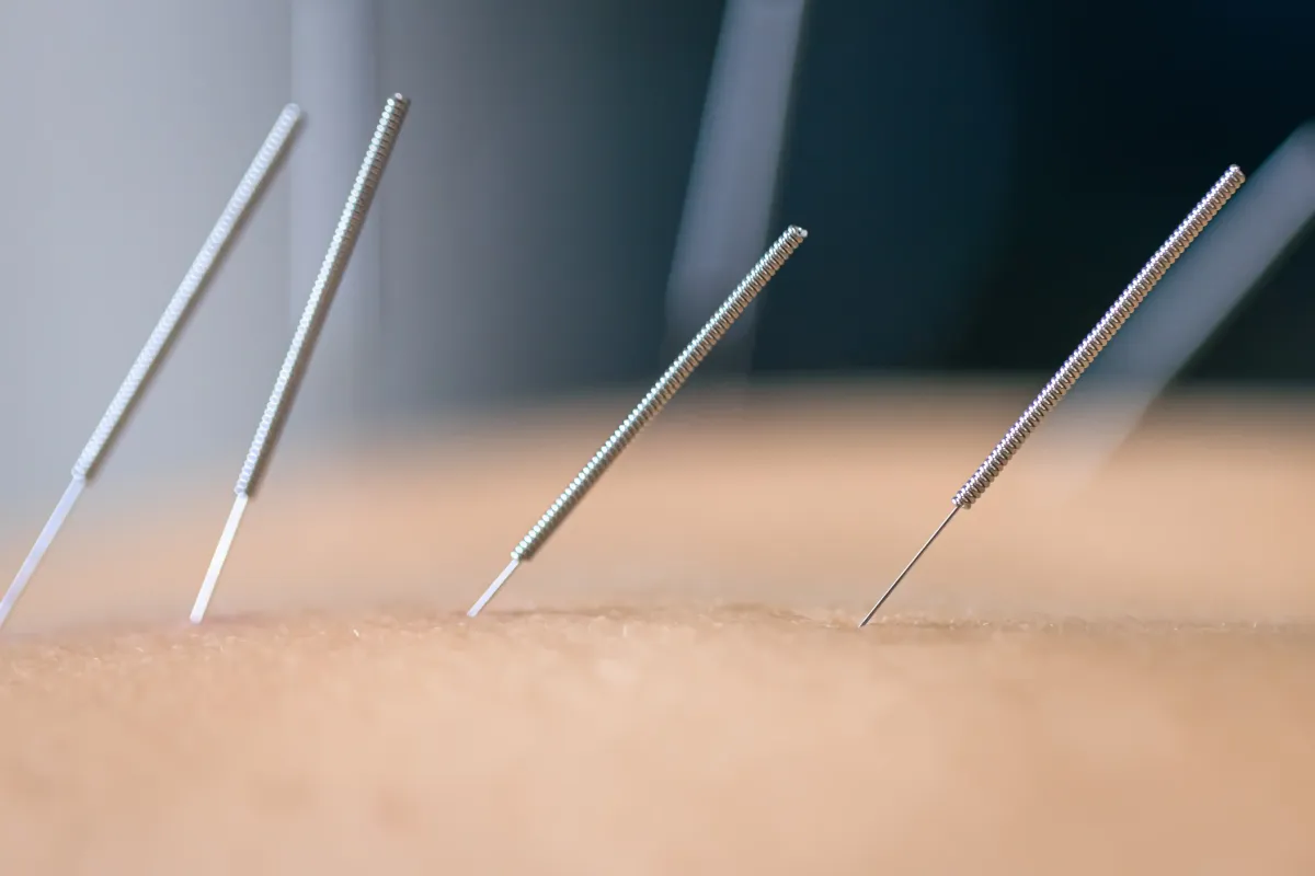 Dry Needling for Hip Pain in NJ