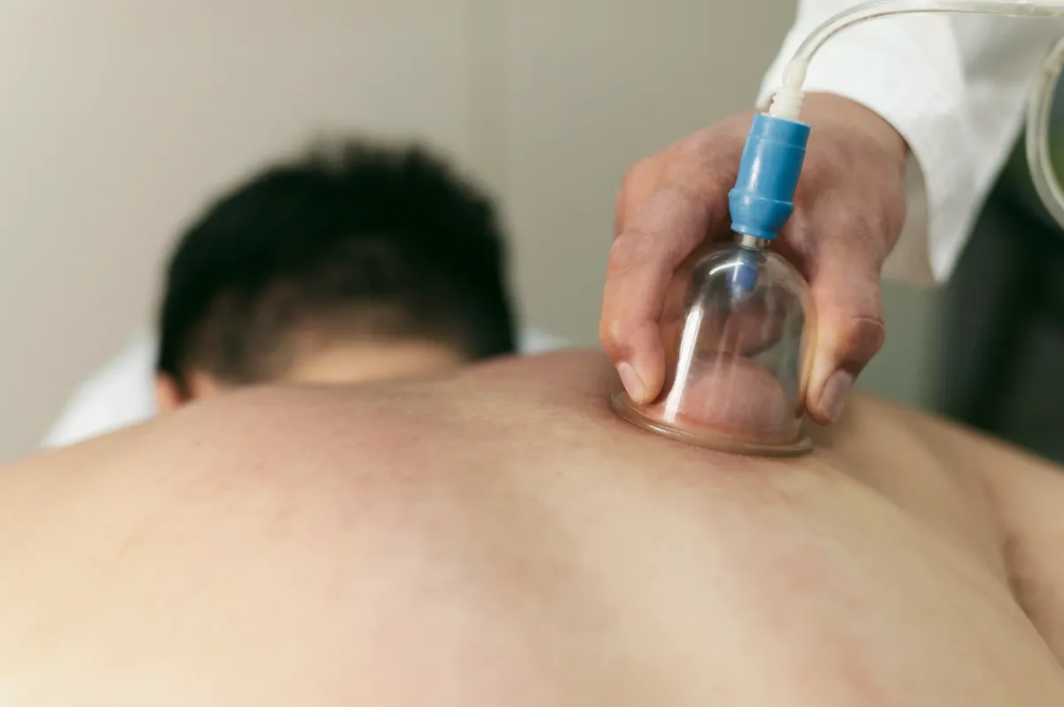 Cupping Therapy for Muscle Pain in NJ