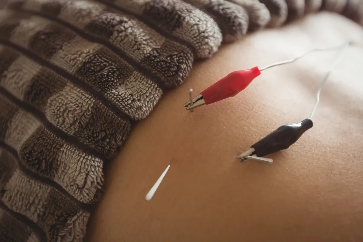 Acupuncture for Gluteus Medius Pain in NJ