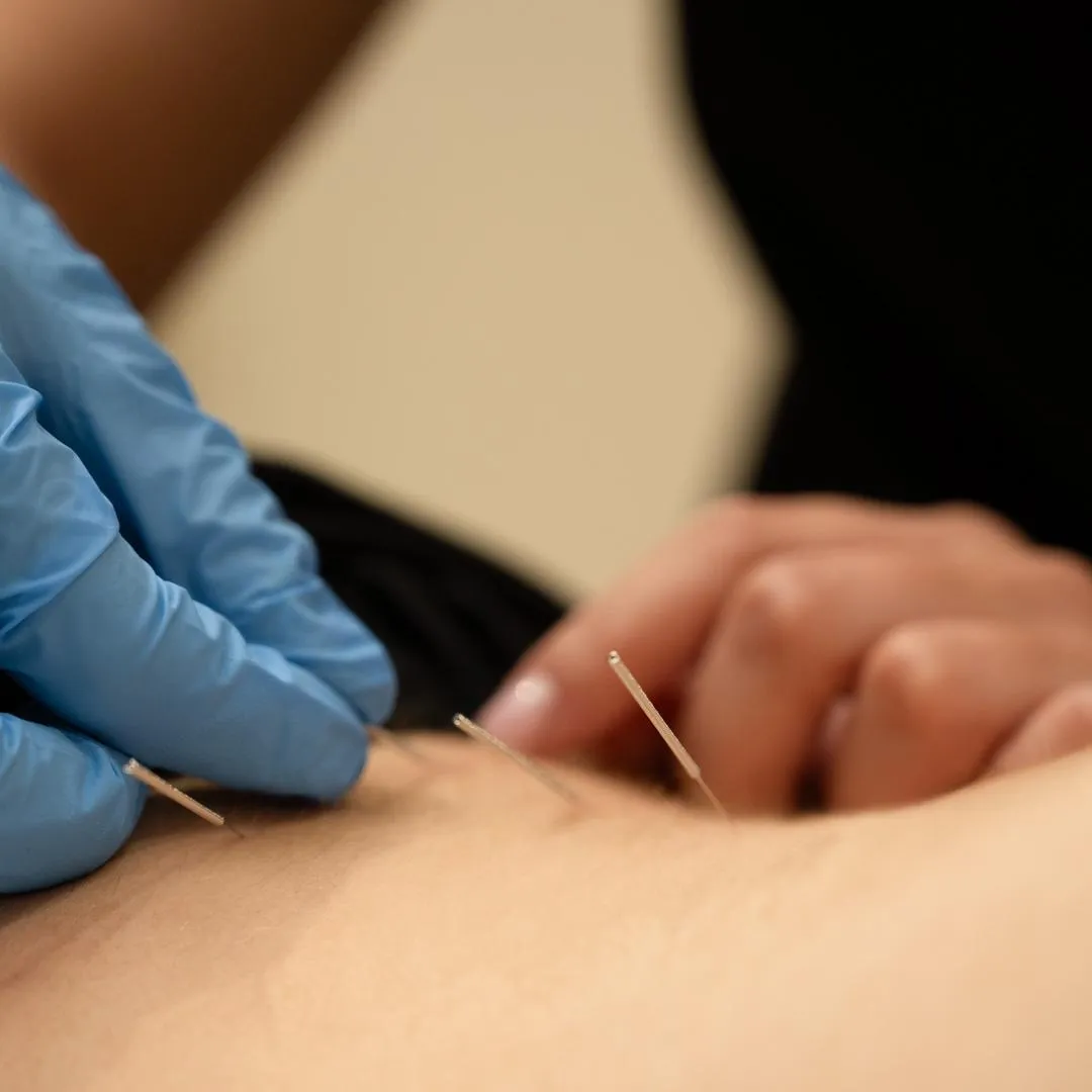 Dry needling