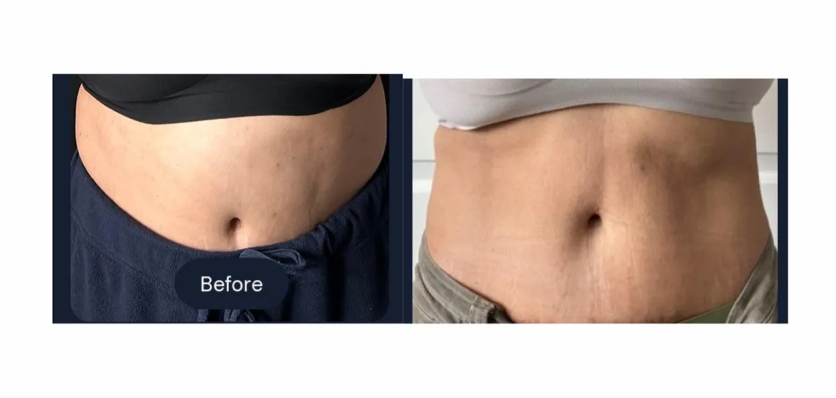 Double Chin Removal