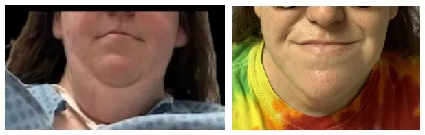 Double Chin Removal