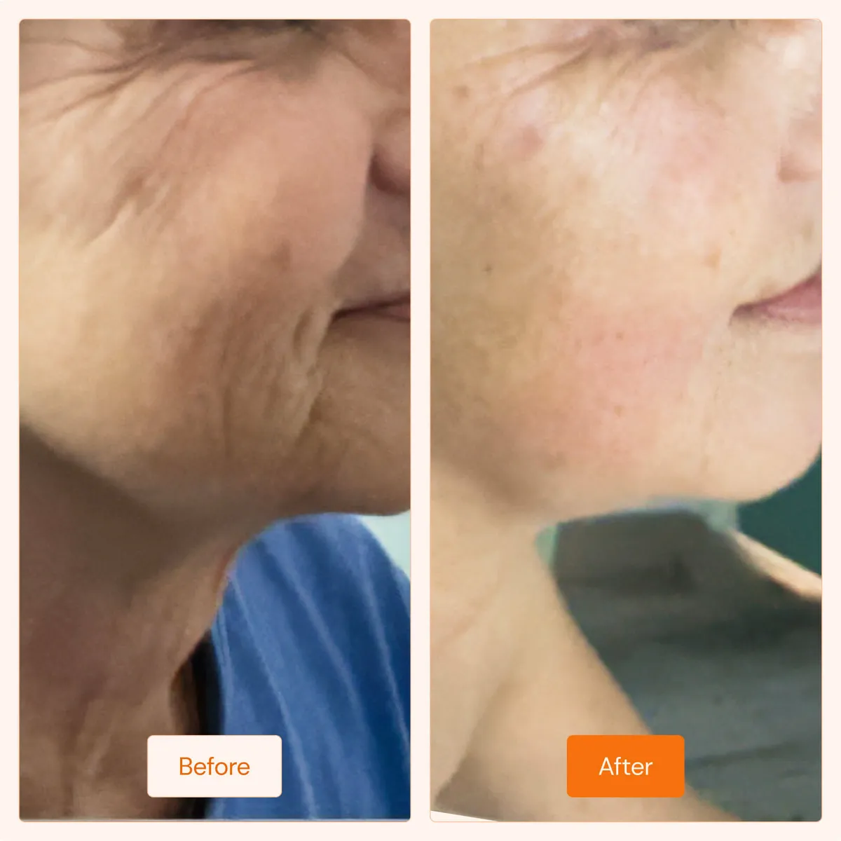 Chin Contouring