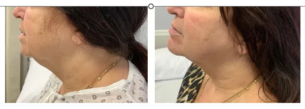 Double Chin Removal