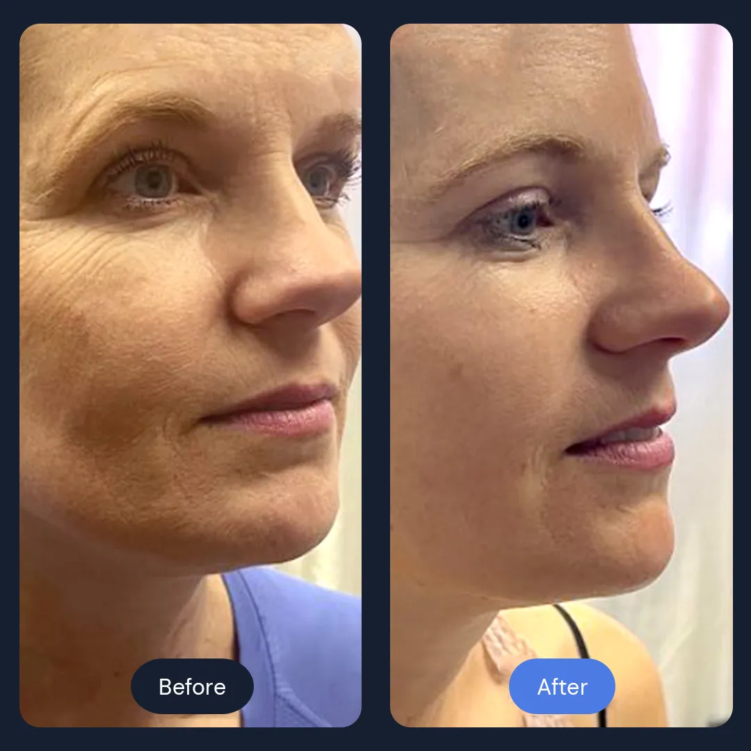 Double Chin Removal