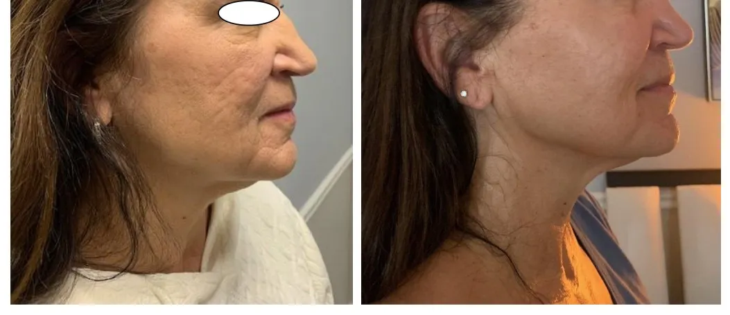Double Chin Removal