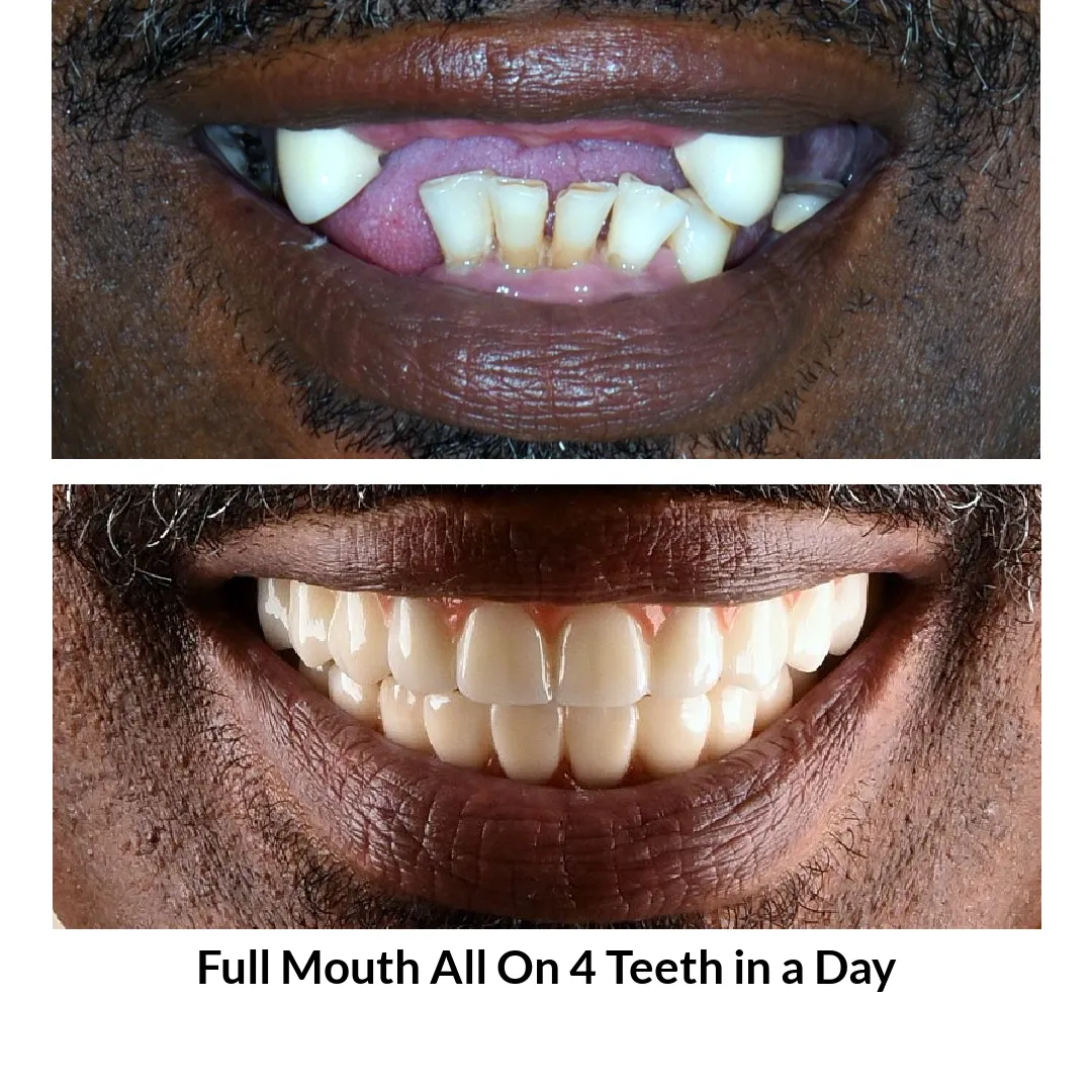 Full Mouth All on 4 Teeth in a Day Photo