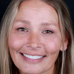 Smile Makeover