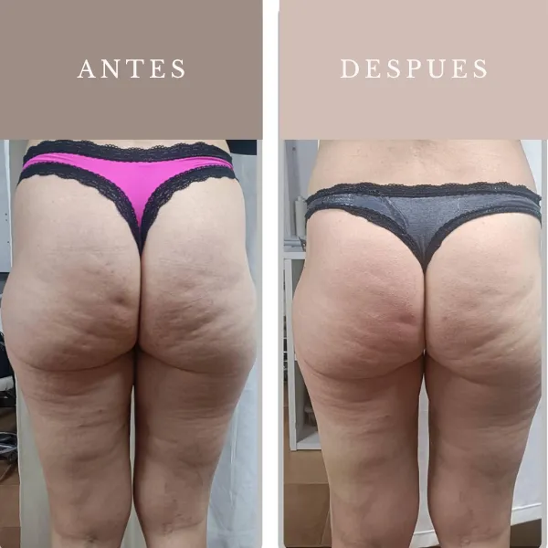 Resultado antes y después de una diatermia de gluteos
