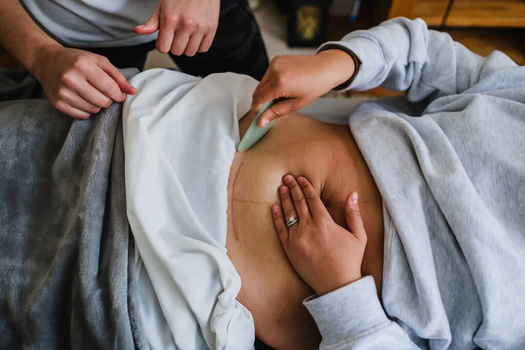 How Your C-Section Scar Is Causing Your Pain