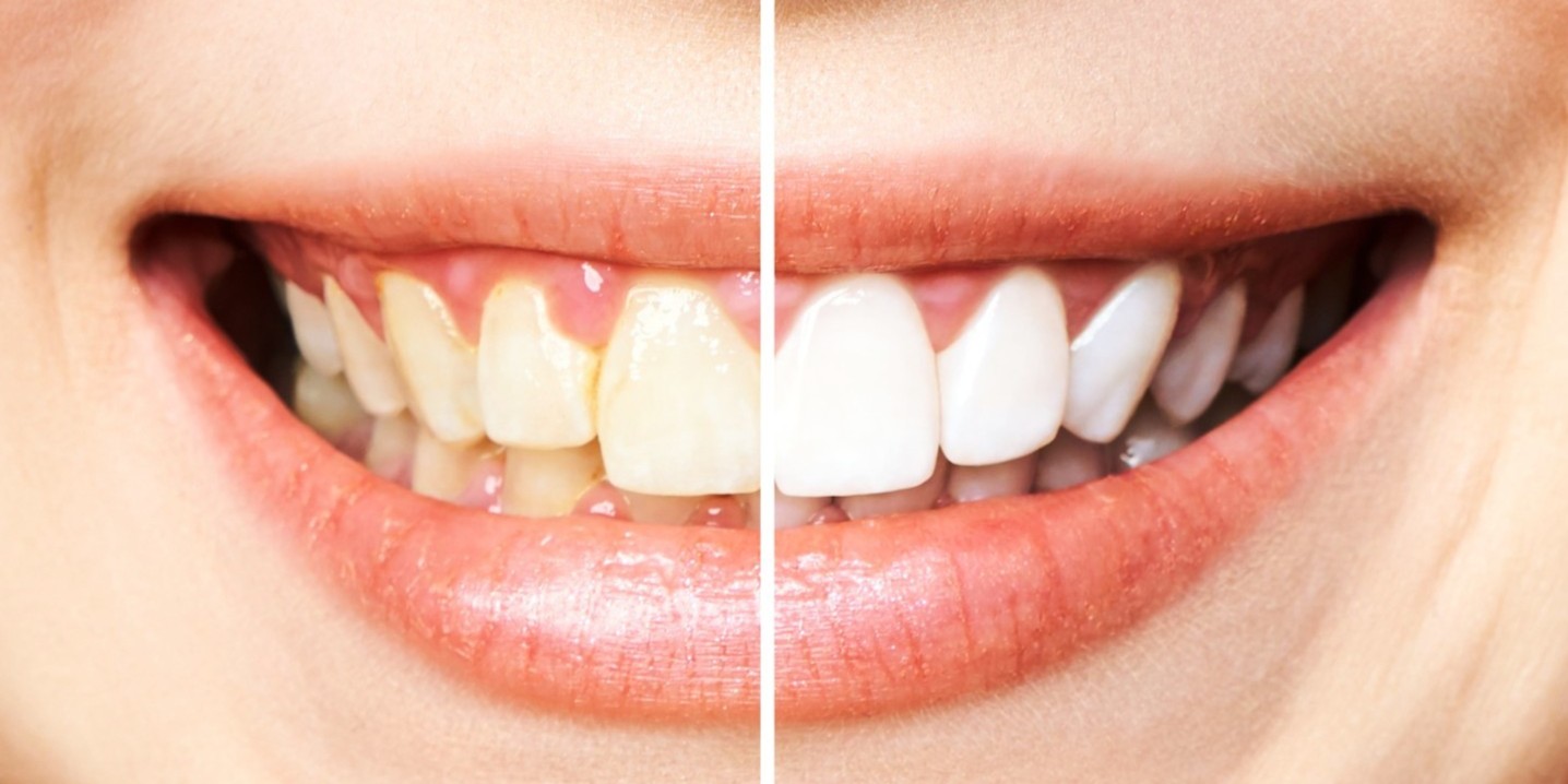 Professional teeth whitening in Alor Setar for brighter smiles