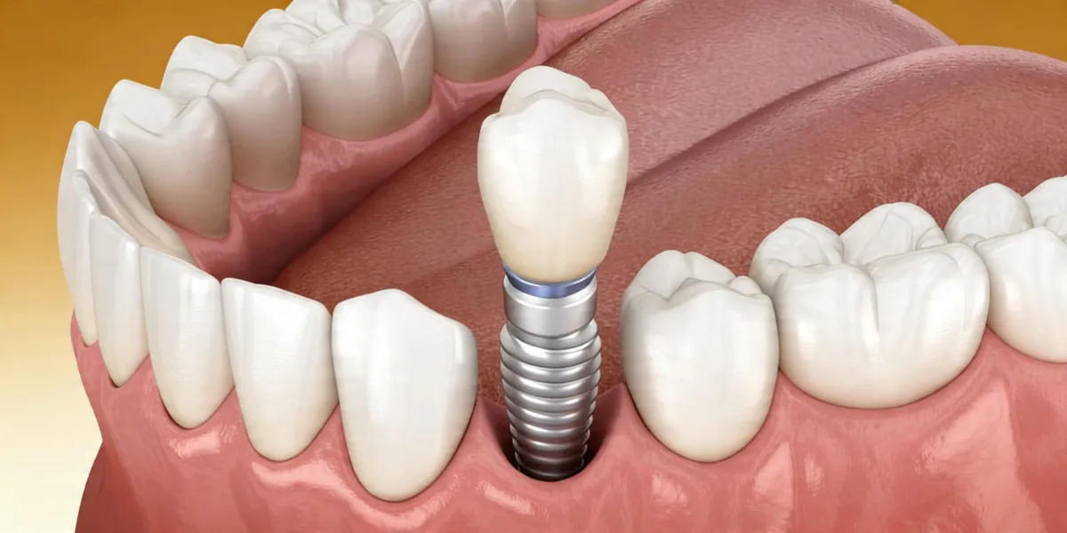 Dental implant procedure in Alor Setar – natural tooth replacement