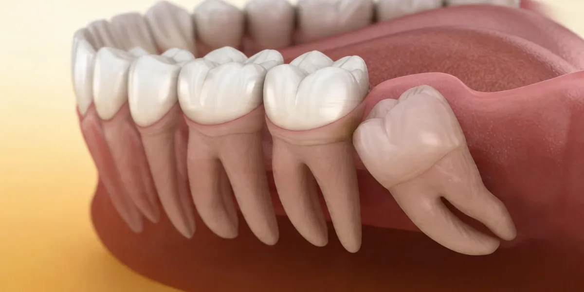 wisdom tooth removal in alor setar