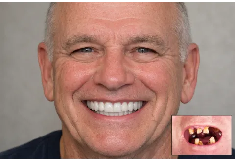 Image of dental patient smiling with new implant supported teeth
