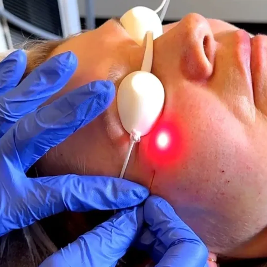 Visual representation of Endolift laser action in deeper tissue layers