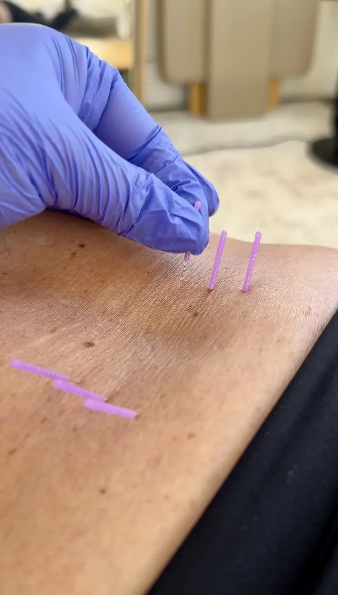 Dry Needling Therapy