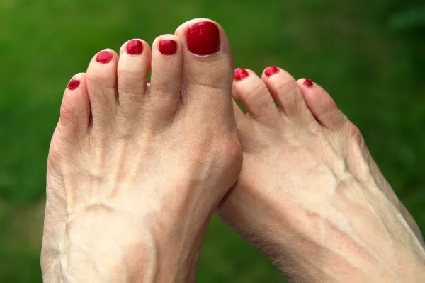 Are Bunions Hereditary, or Are Your Shoes to Blame? | Plymouth Podiatry