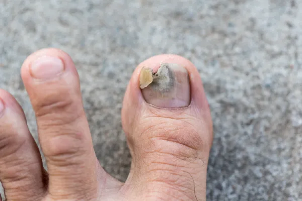 Fungal Nail Treatment in Plymouth: Why Won’t My Fungal Nail Go Away?