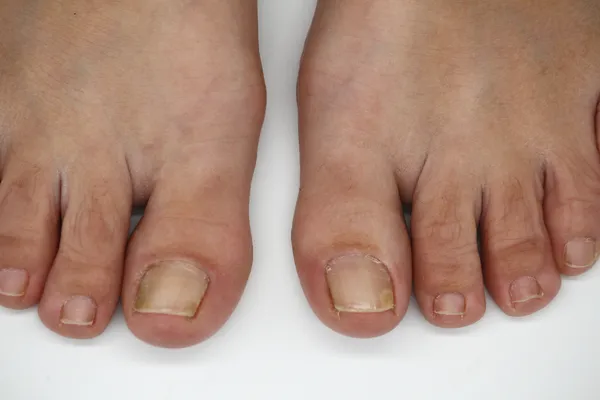 Fungal Nails in Plymouth: Is That Thick Yellow Toenail Really a Fungal Infection?