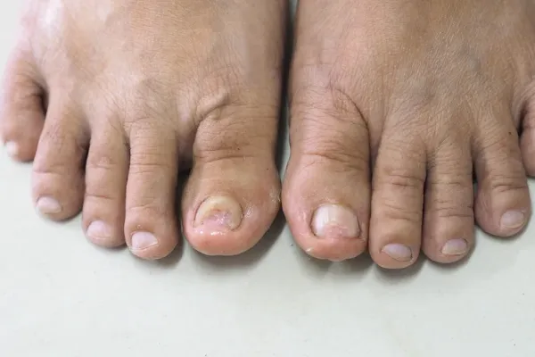 Fungal Nail Treatment in Plymouth: Why Fungal Toenails Can Be So Stubborn
