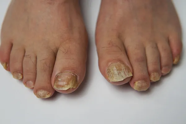 Why Do My Toenails Keep Getting Thicker? Podiatry Advice in Plymouth