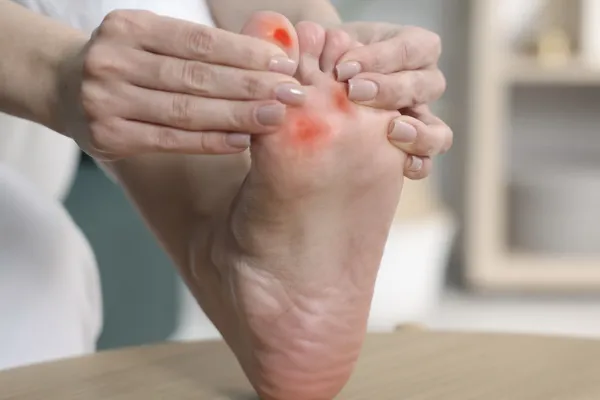 Corns vs Calluses: What's the Difference and When Should You Get Them Treated?