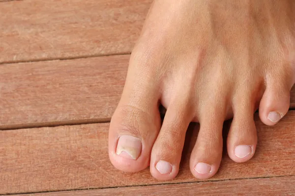 Painful Cracked Skin Between Your Toes? When to See a Podiatrist in Plymouth