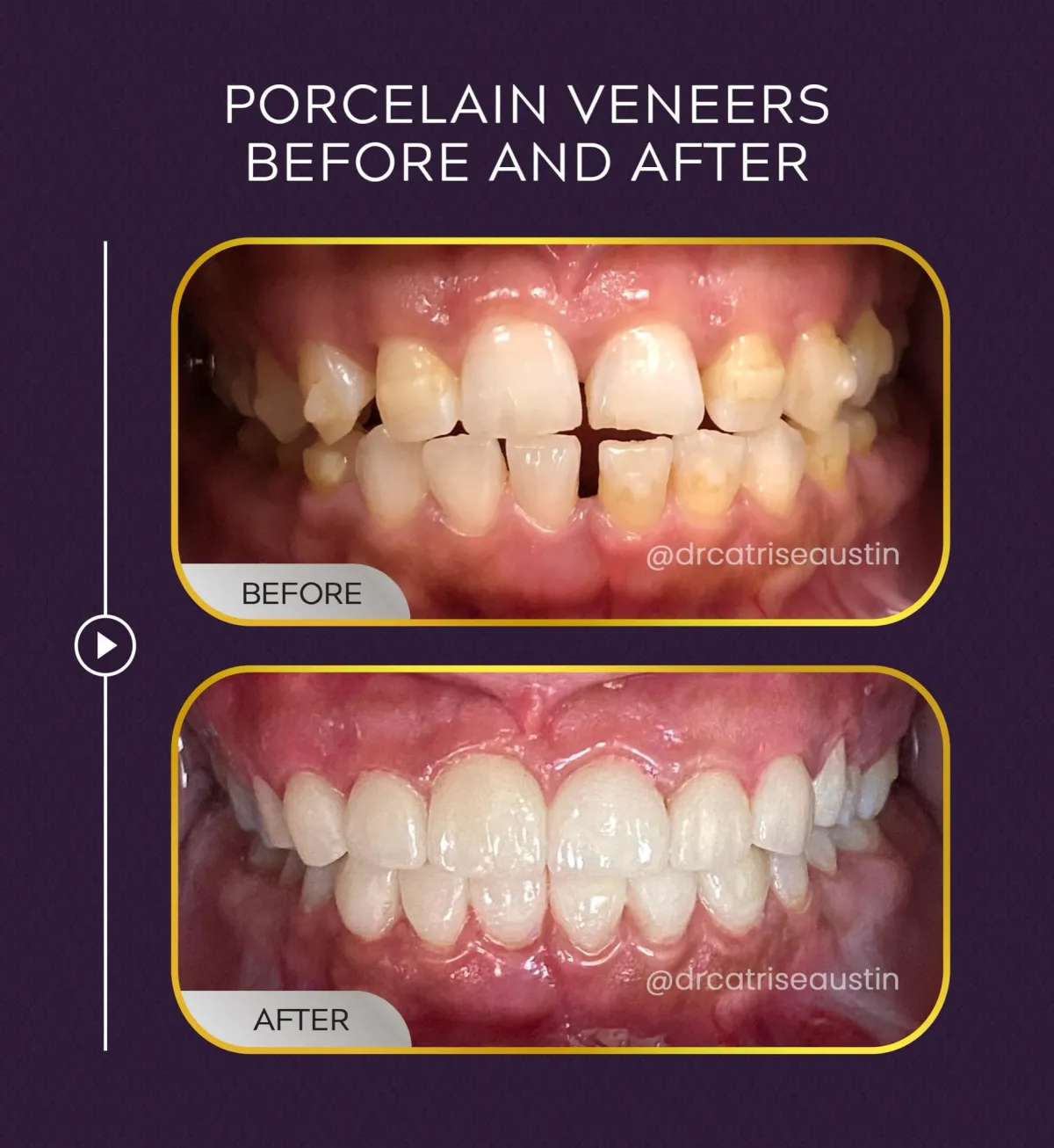 After veneers close-up smile