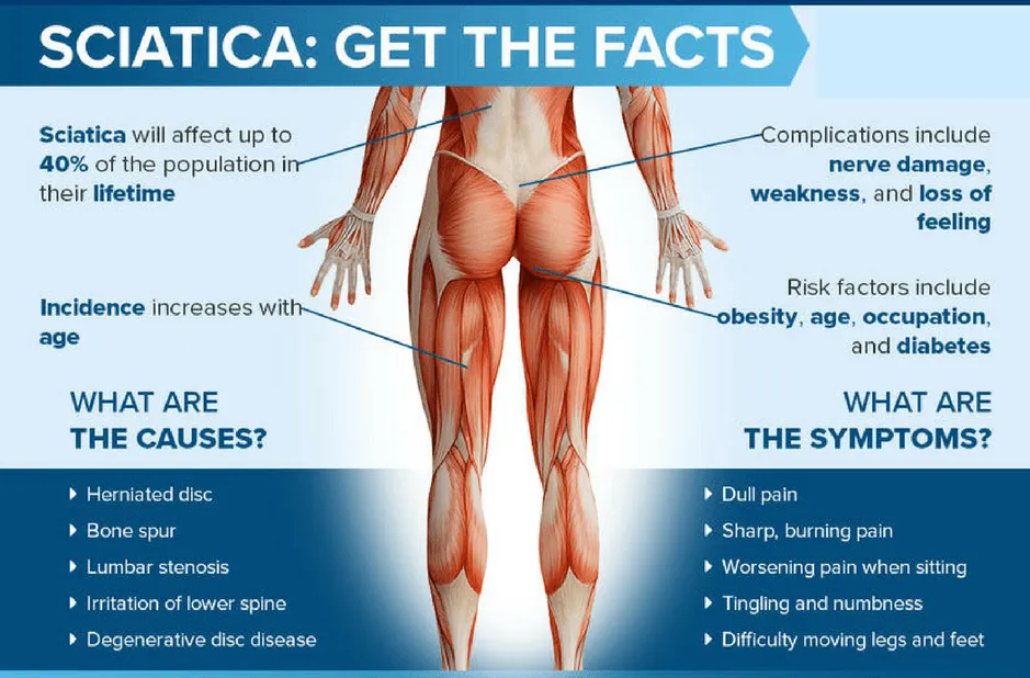 WHAT'S CAUSING MY SCIATICA