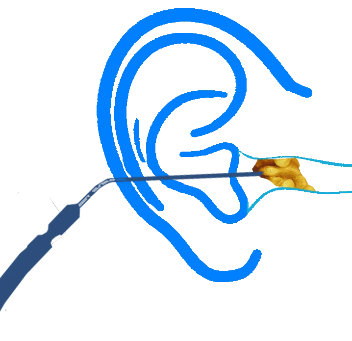 microsuction earwax removal