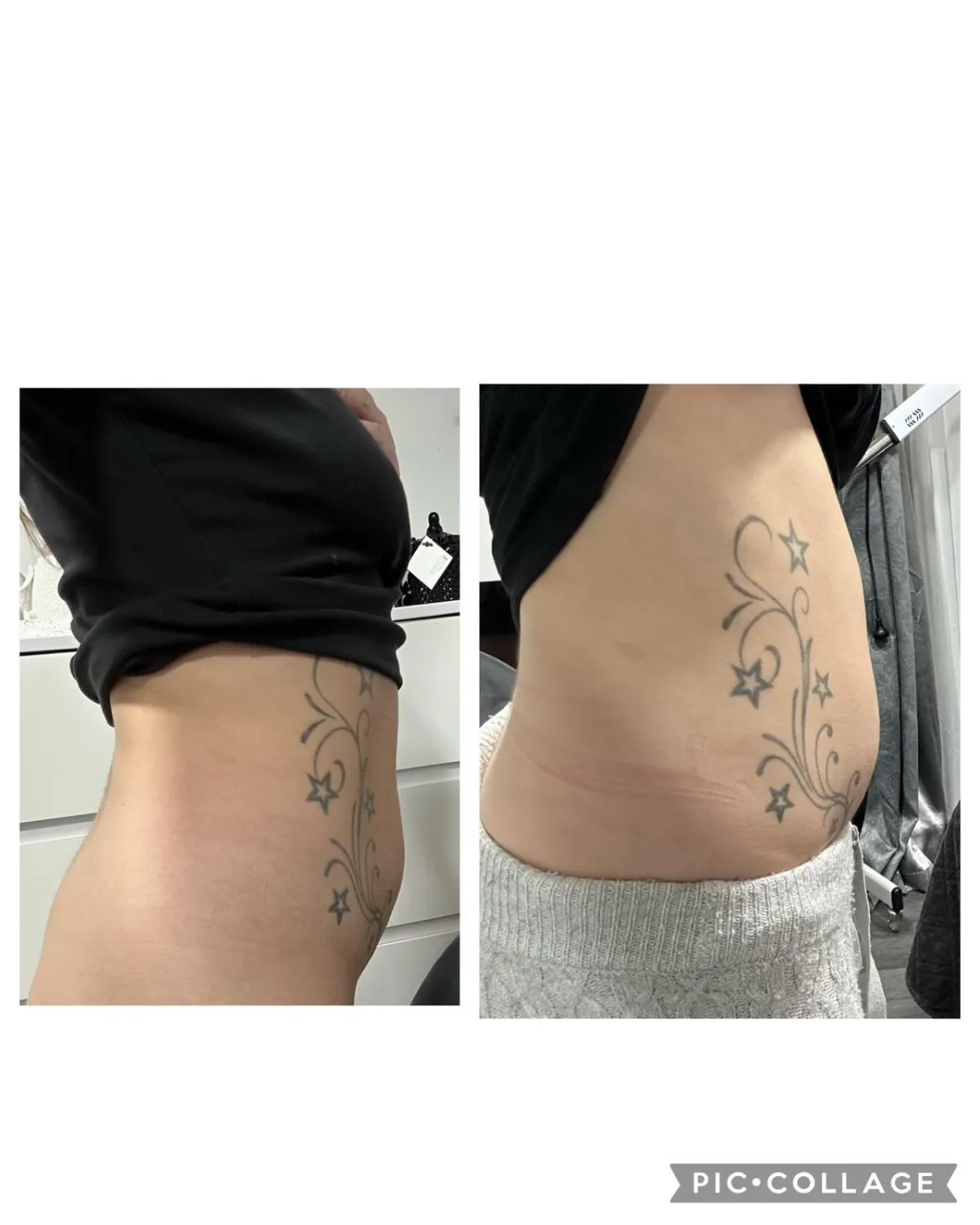Side view showing noticeable waistline reduction and improved contour after body sculpting session.