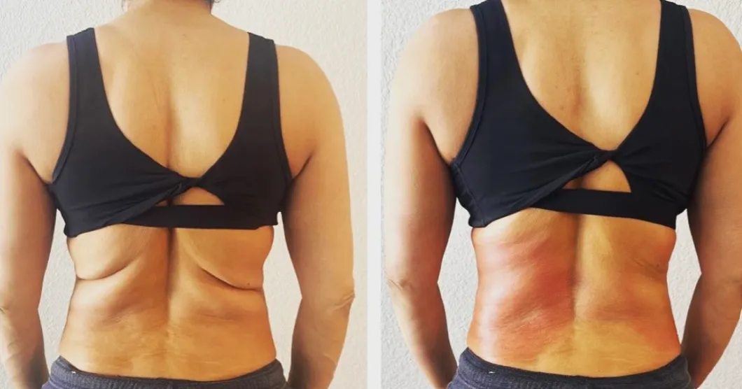 Post GLP-1 muscle and skin treatment