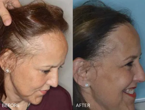 Womens Hair Restoration