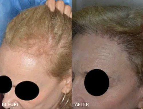 Womens Hair Restoration