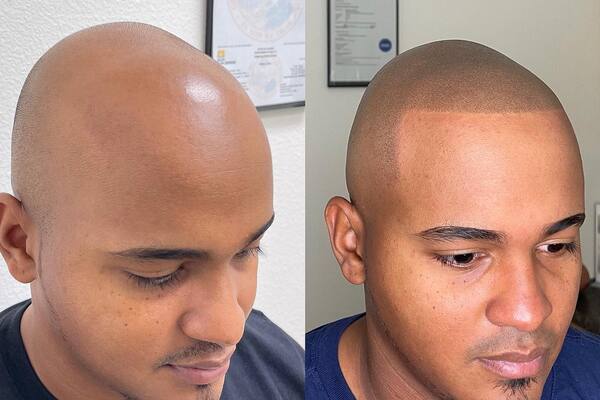 SMP vs Hair Transplant: Which Hair Loss Solution Works Best in 2026?