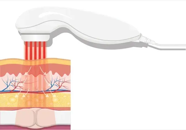 Cold Laser Therapy in Grand Rapids, MI | Drug-Free Pain Relief