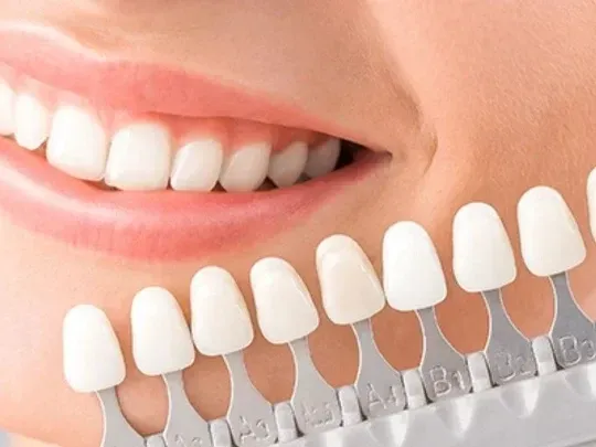 teeth whitening in houston tx