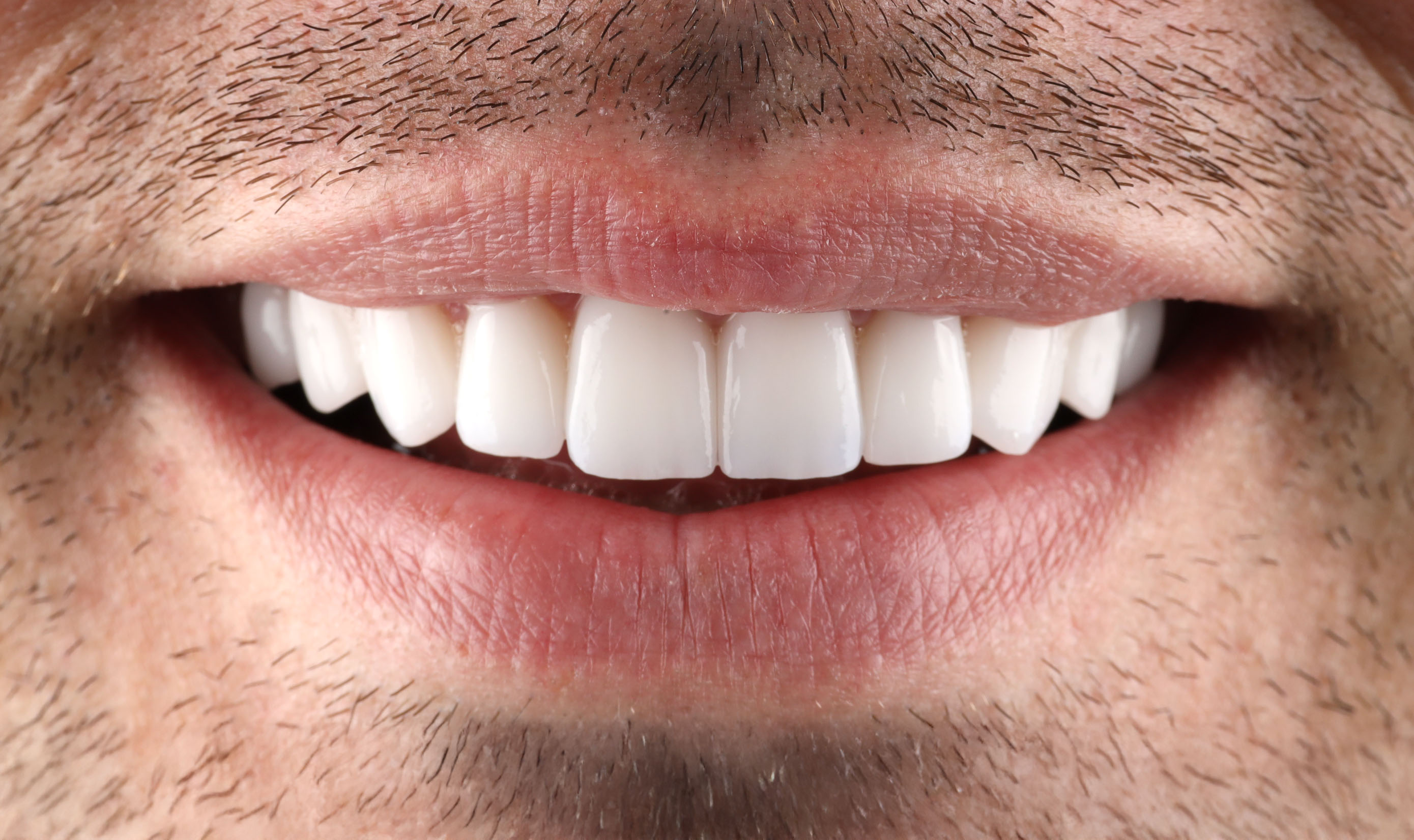 Cosmetic dentistry smile makeover before and after Austin Tx